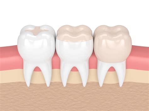 Maybe you would like to learn more about one of these? Fillings - KidzSmile