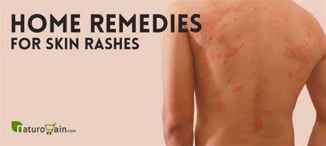 9 home remedies for skin rashes and itching that work [naturally]
