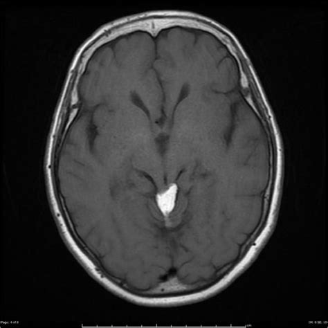 Quadrigeminal Plate Cistern Lipoma Mri Demonstrates A Mass In The