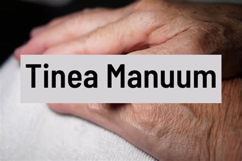 Ringworm On Hands And Fingers Tinea Manuum