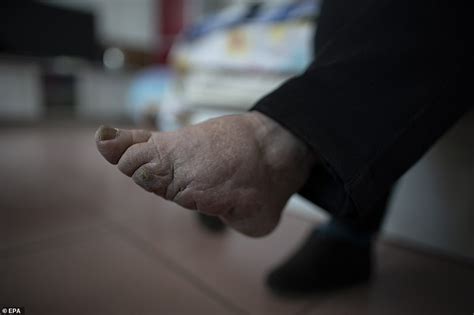 Grandmother Uncovers Her Deformed Bound Feet Which Were Supposed To