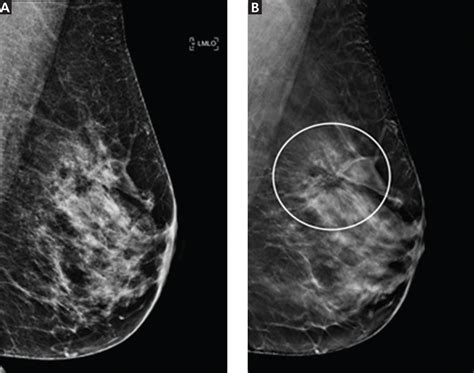 breast cancer screening does tomosynthesis augment mammography cleveland clinic journal of