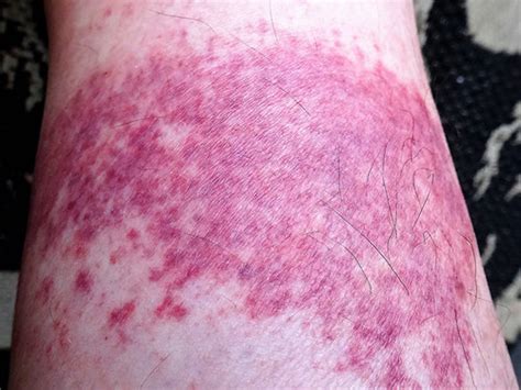 How Long Does A Chafing Rash Last No More Chafe Thigh Guards