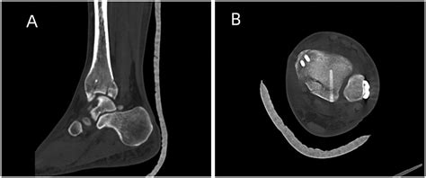 Fracture Gap Of The Lateral Malleolus Via Posterolateral Approach