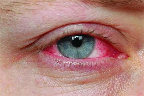 Pink Eye Conjunctivitis Causes Symptoms Diagnosis And Pink Eye Treatment