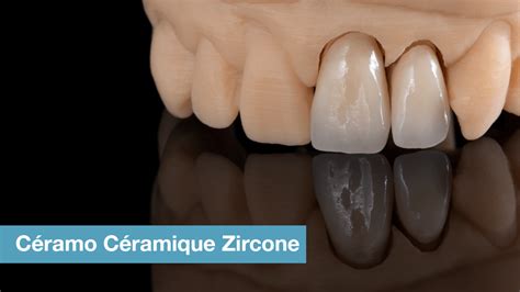 Couronne ceramo ceramique zircone Laboratoire de prothèses dentaires Crown Ceram