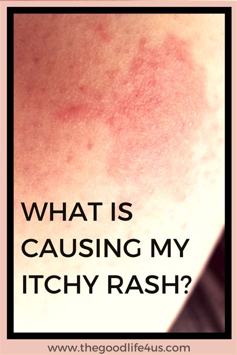 What Is Causing My Itchy Rash Thegoodlife4us