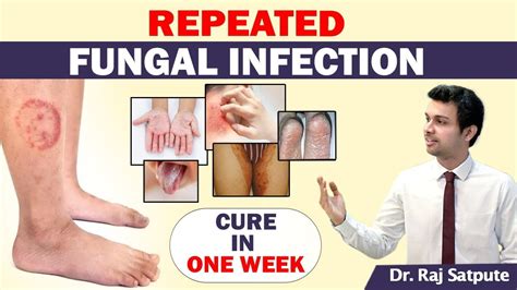 2 Reasons Why Ayurveda Cures Fungal Infection How To Get Rid Of Any