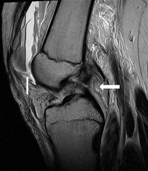 Sagittal T Weighted Mri Shows Rupture Of The Anterior Cruciate My Xxx Hot Girl