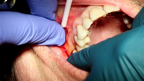 How To Drain A Tooth Abscess Crista Cowles
