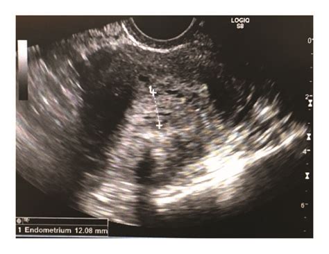 Ultrasound Imaging Of Uterus Demonstrating A 121 Mm Endometrial Stripe