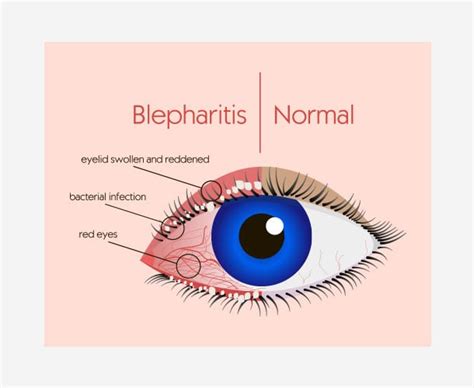 Different Types Of Eye Infections Explained Spectacular By Lenskart