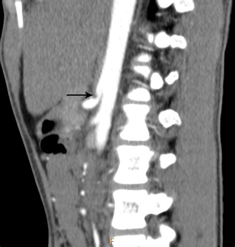 Imaging In Median Arcuate Ligament Syndrome Bmj Case Reports