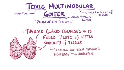 Toxic Multinodular Goiter Osmosis