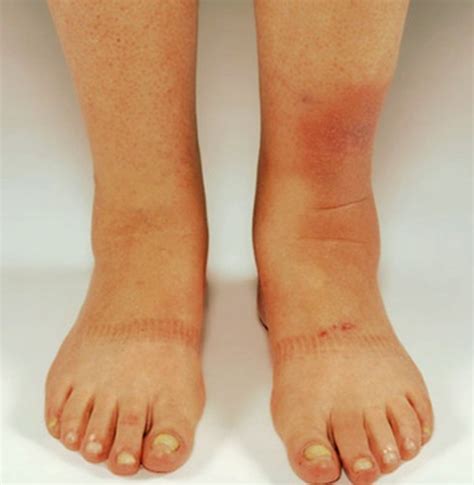Pretibial Myxedema Pictures Treatment Symptoms Causes