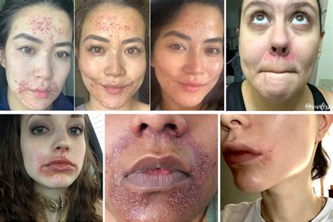 How I Cured My Perioral Dermatitis—the Skin Condition Youve Never