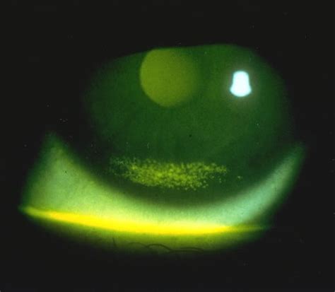 Tricks of the Trade: Fluorescein application techniques for the eye