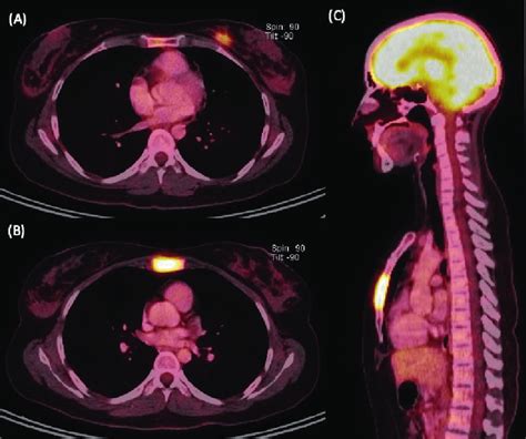 Staging Image Study A Axial View Of Petct Showing A Hypermetabolic