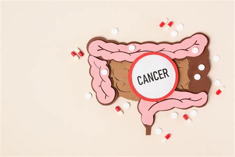 The Different Stages Of Colon Cancer