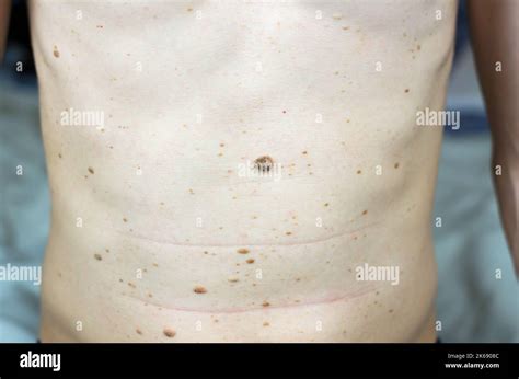 Maulwürfe Warzen Und Papillome Auf Der Menschlichen Haut Erkrankungen