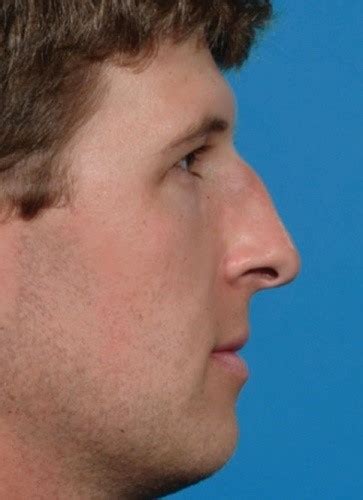 Crooked Nose Treatment Singapore Allure Plastic Surgery Dr Samuel Ho