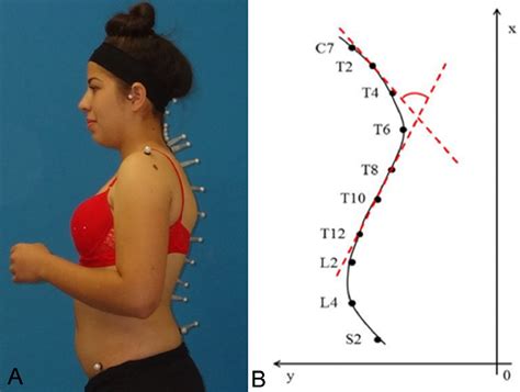 Validating Surface Topography For The Measurement Of The Thoracic Kyphosis Angle In Patients