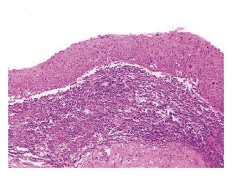 Histopathologic Examination Of The Excised Cervical Lymph Node Revealed