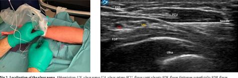 Figure 2 From Efficacy Of Ultrasound Guided Forearm Nerve Block Versus