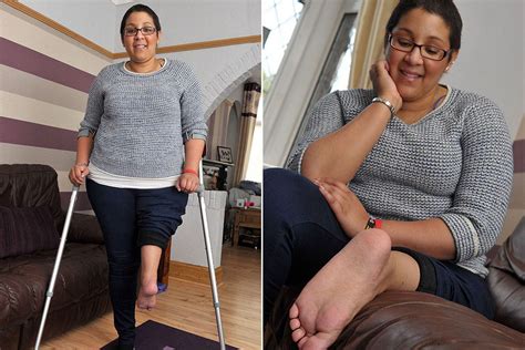Amputee Woman Has Ankle Made Into Knee Mirror Online