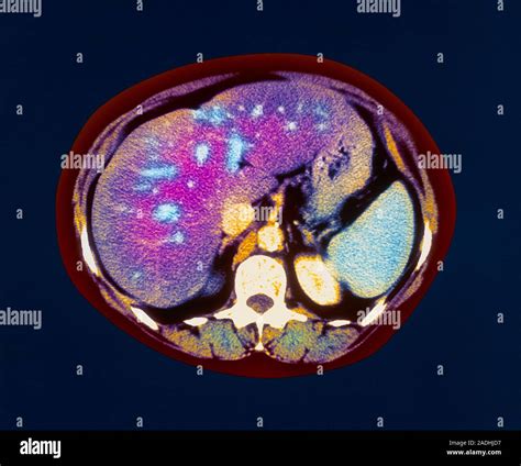 Fatty Liver Coloured Computed Tomography Ct Scan Of An Axial Section