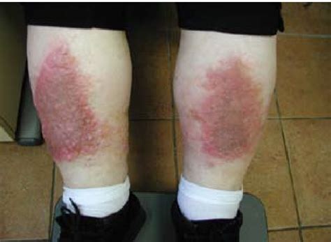 Edema And Erythematous Lesion On Lower Legs Of The Patient Download