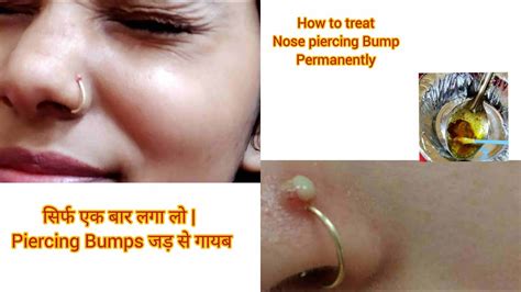 How To Remove Nose Piercing Bumps Home Remedies To Remove Bump Get Rid Of Nose Piercing Bump