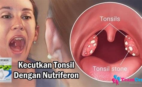 Sakit Tonsil Acute Tonsillitis Rawatan Dan Cara Hilangkan Sakit Tonsil