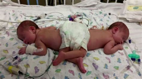 Photos Surgery Separates Infant Conjoined Twins 6abc Philadelphia