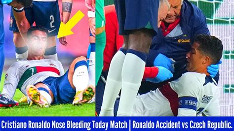 Cristiano Ronaldo Nose Bleeding Today Match Ronaldo Accident Vs Czech