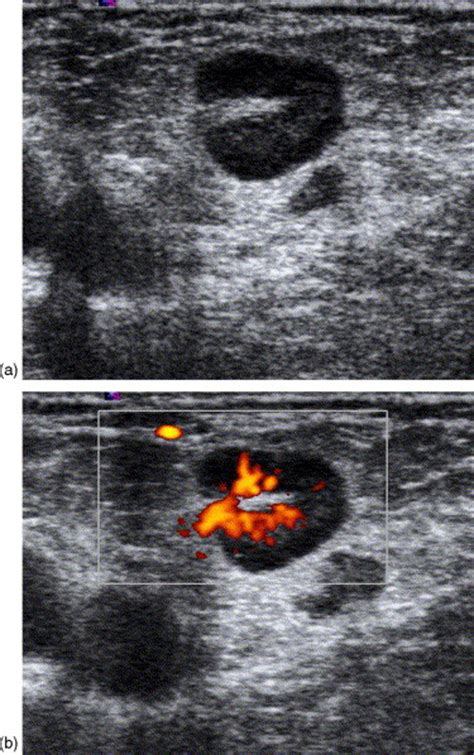 Ultrasound Of Superficial Lymph Nodes European Journal Of Radiology
