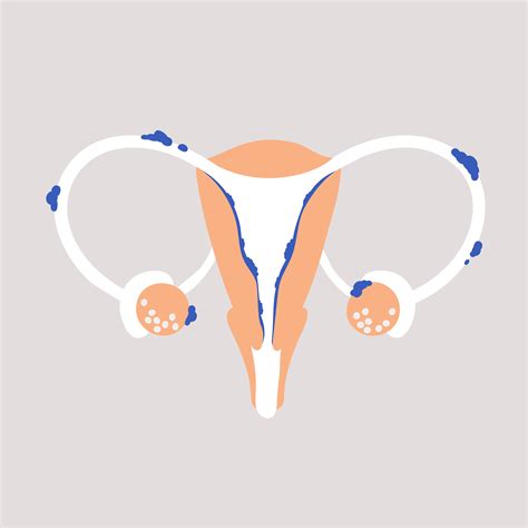 Endometriosis The Disease Impacting 176 Million Women — Endometriosis