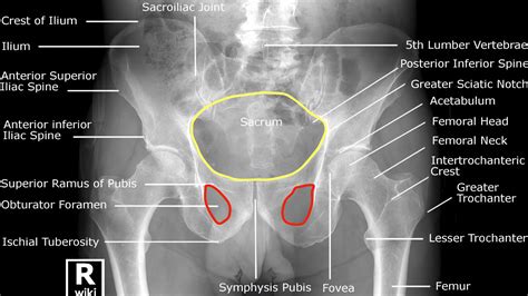 Hip X Ray Interpretation Osce Guide Geeky Medics