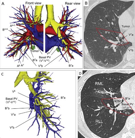 A C Three Dimensional Computed Tomography Angiography And