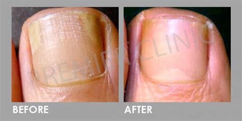 Nail Fungus And Infection Laser Treatment Premier Clinic Kl Malaysia