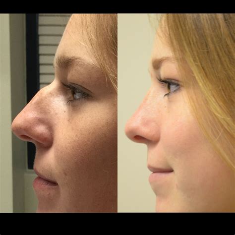 Pin By Morgan Pruitt On Health Nose Hair Removal Rhinoplasty Nose