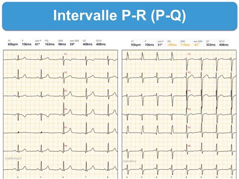 Intervalle P R Pr E Cardiogram