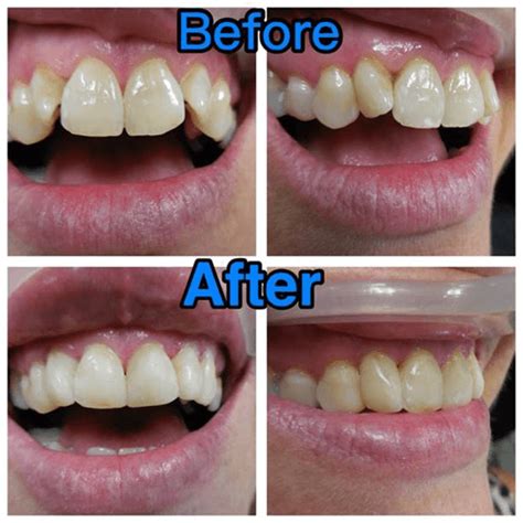 Tooth Bonding Treatments In Guelph Speedvale Dental