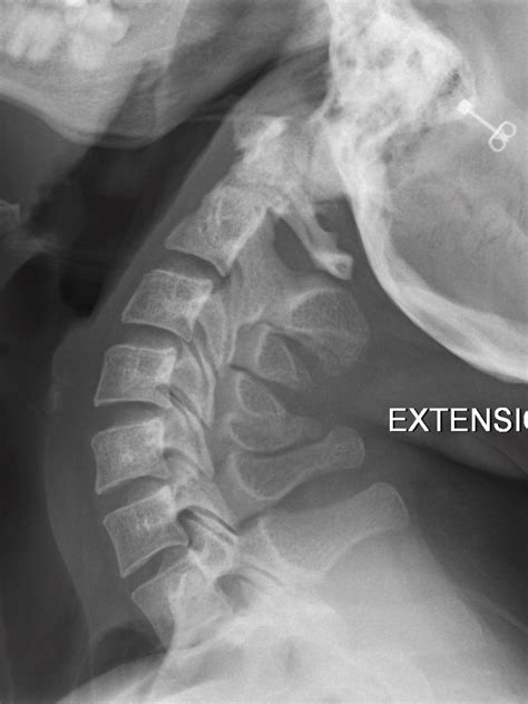 Normal Flexion And Extension Cervical Spine X Rays Radiology Case