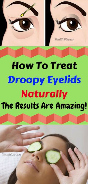 How To Treat Droopy Eyelids Naturally The Results Are Amazing With