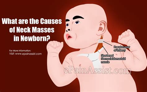9 Causes Of Neck Masses In Newborn And Its Treatment Diagnosis