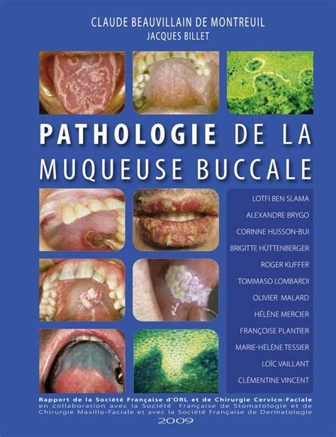 Pathologie De La Muqueuse Buccale