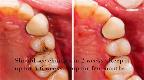 Not only chewing of sesame seeds acts as a natural scrub but it also acts as an effective polishing and cleaning agent for your teeth. Remove Plaque naturally from teeth. How to remove plaque ...