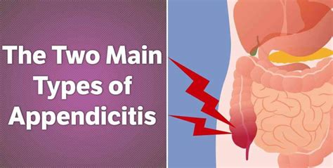 Appendicitis Causes Symptoms And Treatment Health Blog