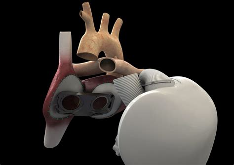 Artificial Heart With Norwegian Sensor